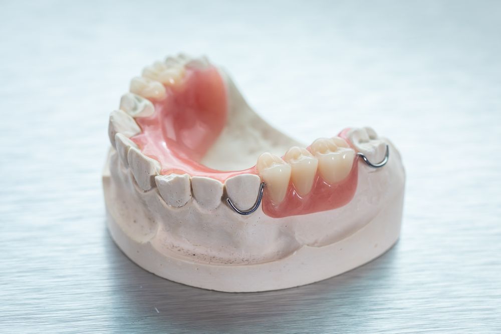 Implant Retained Dentures